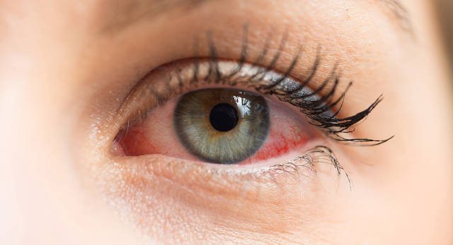 Красные глаза: снимаем усталость органов зрения – глазная клиника «МЕДИНВЕСТ»
