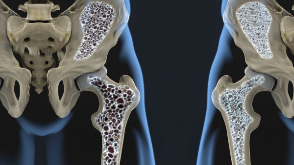 Механизм развития остеопороза